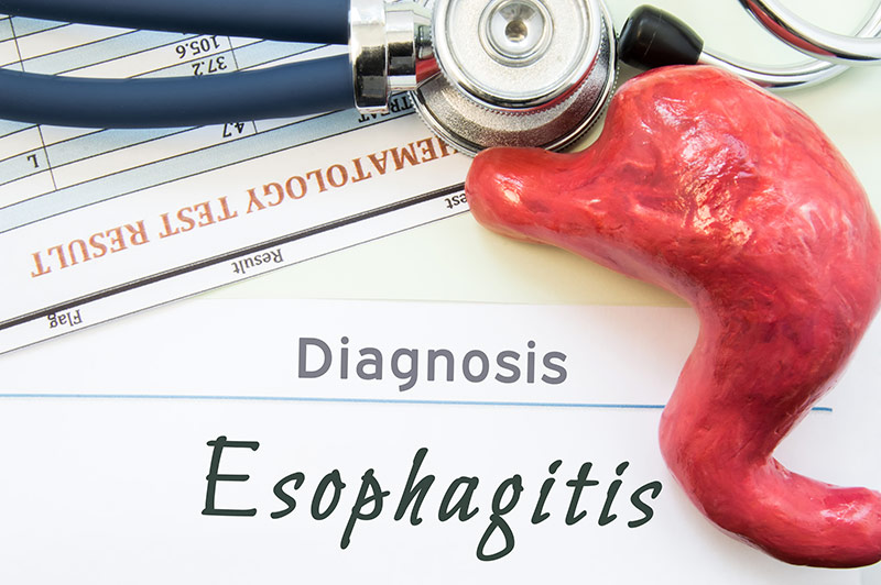 Erosive Esophagitis Clinical Study in Phoenix, Arizona