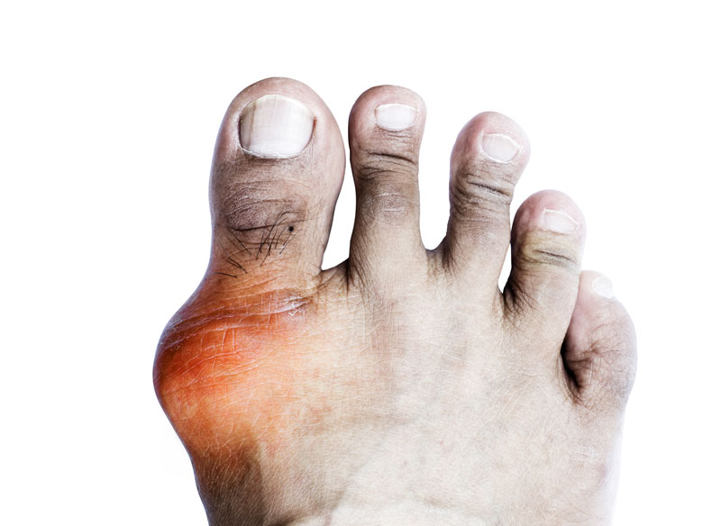 Gout Clinical Study