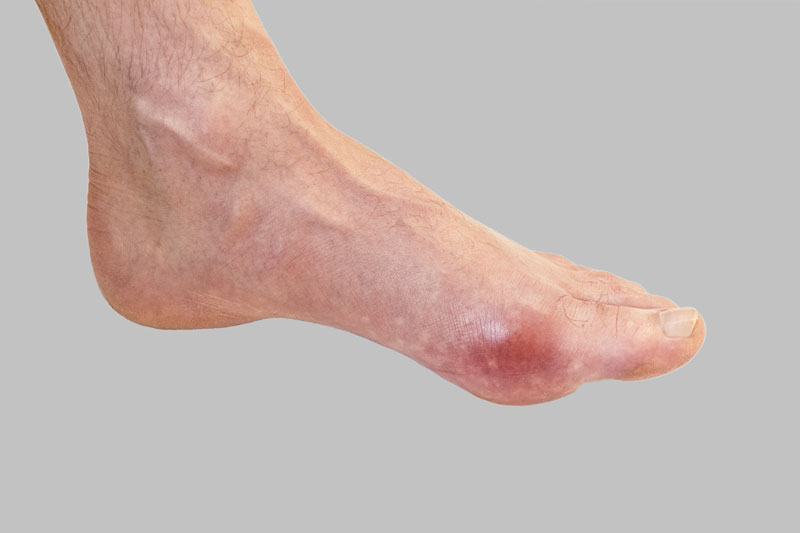 Gout Causes and Symptoms