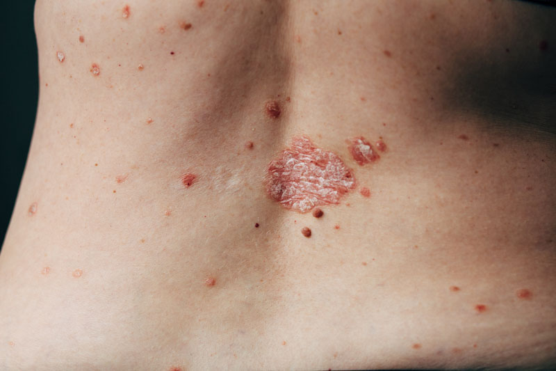 Atopic Dermatitis Picture