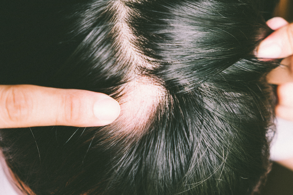 Alopecia Clinical Trial Study in Arizona Alopecia Clinical Trial Study in Arizona